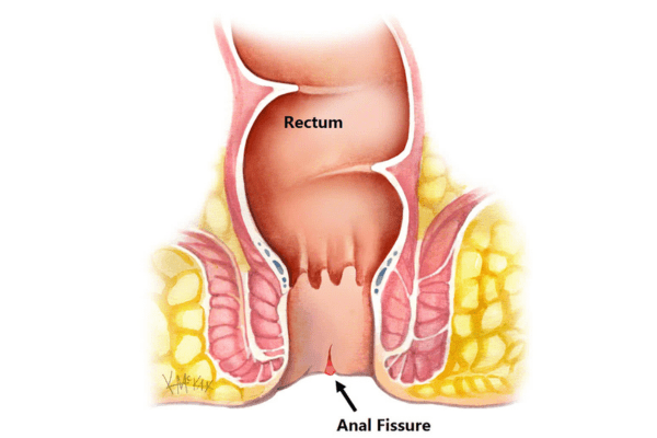 Fissure Specialist in Thrissur